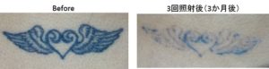 圧倒的症例数　ピコレーザー（エンライトン）によるタトゥー除去。治療3か月後
