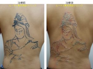 圧倒的症例数　ピコレーザー（エンライトン）によるタトゥー除去