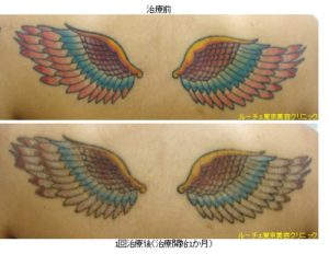 タトゥー除去ピコレーザー461＠ルーチェクリニック