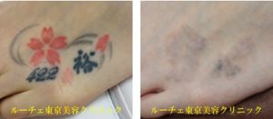 足の甲7回黒赤2色タトゥー