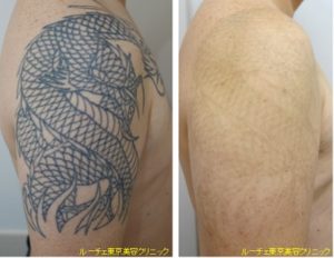 7回で取れた腕タトゥー