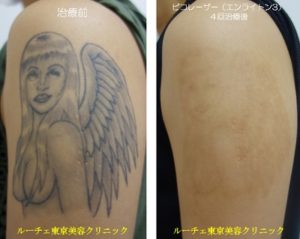 ピコレーザー（エンライトンⅢ）で肩～腕のタトゥーをとります