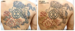 タトゥー除去ピコレーザー371＠ルーチェクリニック