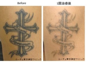 タトゥー除去ピコレーザー0036＠ルーチェクリニック