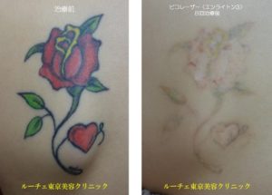 タトゥー除去ピコレーザー159＠ルーチェクリニック