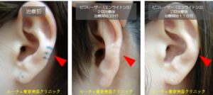 耳の黒いタトゥーが２度のピコレーザー治療で消えました＿