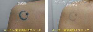 背中の水色のタトゥーにピコレーザー治療を１０回行いました。