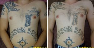 タトゥー除去ピコレーザー413＠ルーチェクリニック