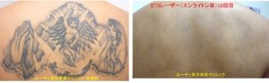 背中上半分の広いタトゥーをピコレーザーで消しています
