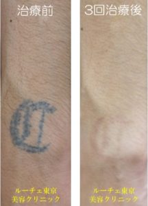 手首のタトゥーが消えて施術が終わりました。