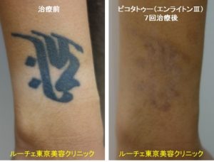 手首黒一色のタトゥーが目立ちにくくなりました