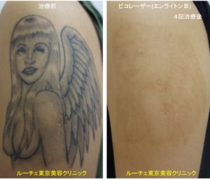 タトゥー除去ピコレーザー114＠ルーチェクリニック