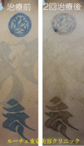 タトゥー除去ピコレーザー297＠ルーチェクリニック