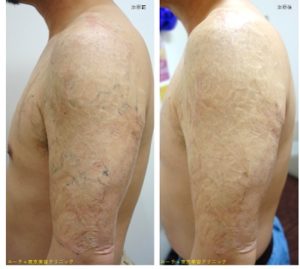 タトゥー除去ピコレーザー245＠ルーチェクリニック