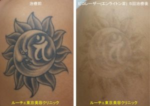 腕のタトゥーをピコレーザーで薄くしている途中経過です