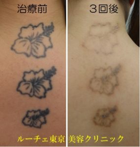 圧倒的症例数 ピコレーザー（エンライトン）でタトゥー除去。３回治療後。