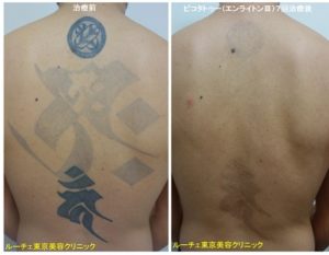 背中一面の黒タトゥーが薄くなりました