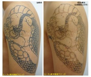 腕の黒タトゥー2回目