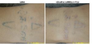 他院修正タトゥー除去