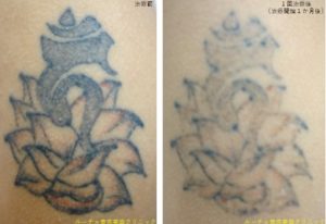 ピコレーザータトゥー除去経過　腕２色黒赤1回照射後