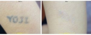 タトゥー除去ピコレーザー235@ルーチェクリニック
