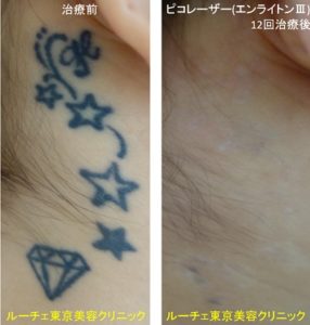 耳裏の星型タトゥーが薄くなり、ほとんどわからなくなりました＿