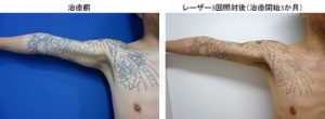 圧倒的症例数ピコレーザー（エンライトン）によるタトゥー除去