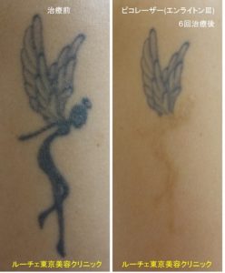 腕の黒一色タトゥーを部分的に消しました。