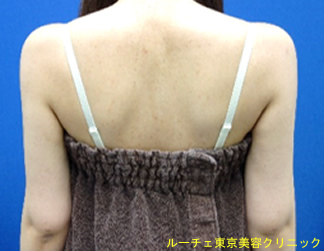 吸引後は華奢な腕に見え、 女性らしい腕のシルエットになりました。