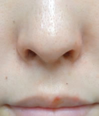 小鼻の幅が小さくなり、 鼻の穴の幅も小さくなりました。