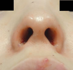 自然な形を維持したまま、鼻の穴は細く小さくなりました。小鼻の幅もほどほどに狭くなりました。