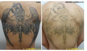 背中の広範囲タトゥー＿