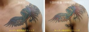 タトゥー除去ピコレーザー320＠ルーチェクリニック
