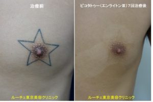 胸の星型タトゥーが7回の治療でインクが取れました。