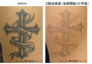 ピコレーザー（エンライトン）でタトゥー除去しています。2回治療後（治療開始から2か月経過）