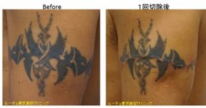 タトゥー除去ピコレーザー0038＠ルーチェクリニック