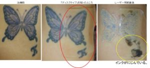 タトゥー除去ピコレーザー457＠ルーチェクリニック