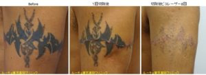 腕のレーザーと切除の組み合わせタトゥー除去