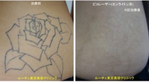 タトゥー除去ピコレーザー122＠ルーチェクリニック