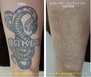 タトゥー除去ピコレーザー208＠ルーチェクリニック