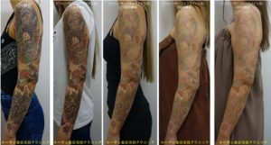 腕の7色カラータトゥー6回