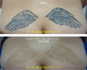 腰のタトゥーにピコレーザーを６回治療しました。