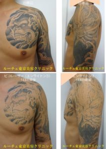 ピコレーザー新着症例です。１度の施術でもこんなに薄くなります＿