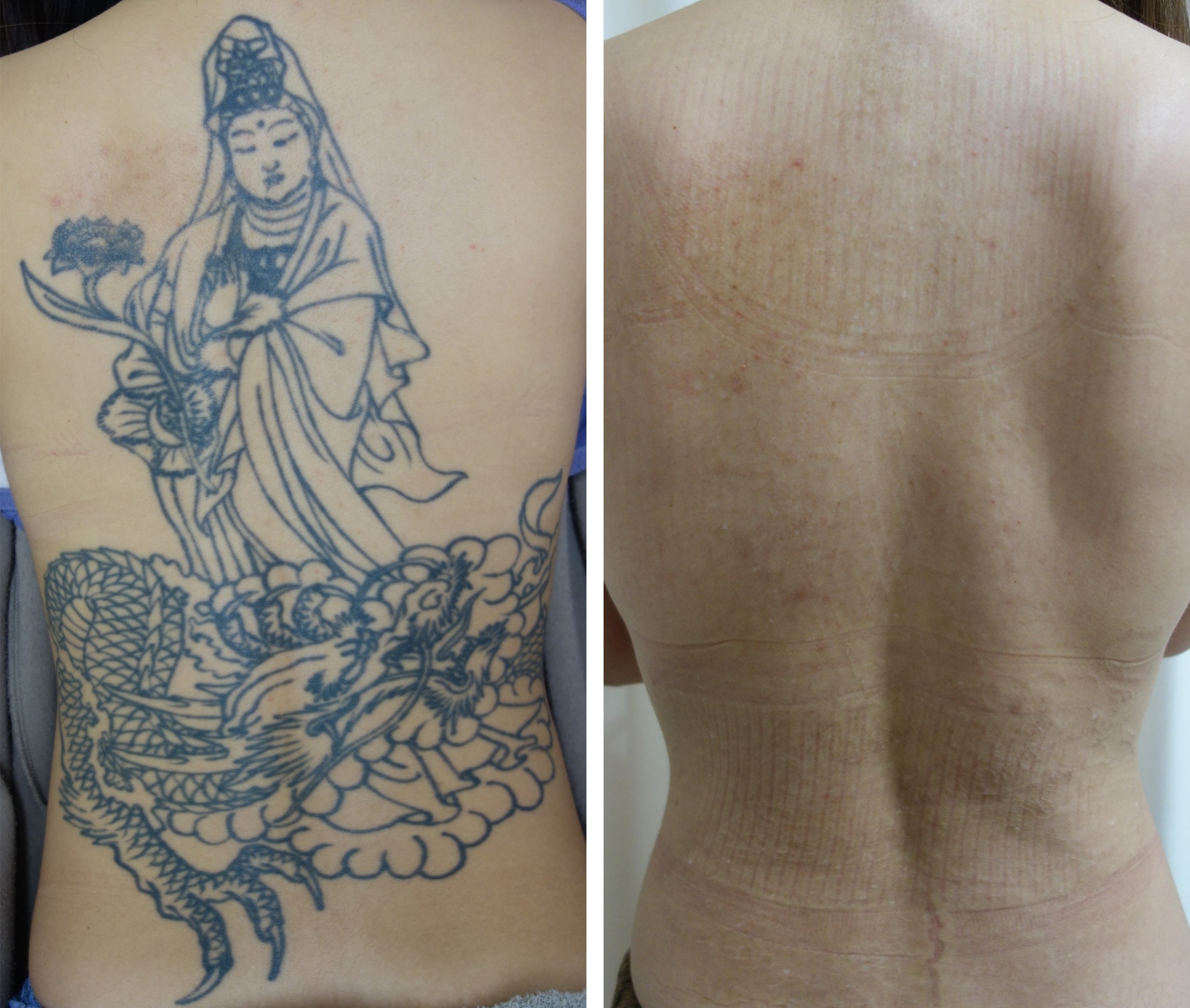 タトゥー除去ピコレーザー症例⑤ルーチェクリニック