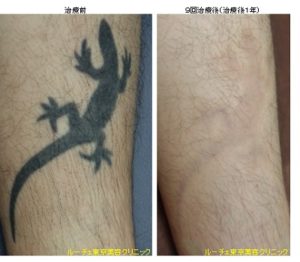ふくらはぎのトカゲタトゥー、とれた