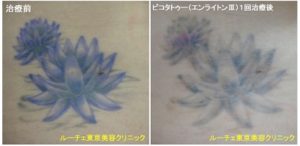 腰の黒と紫の花のタトゥーのインクを取っています。1回　腰　紫
