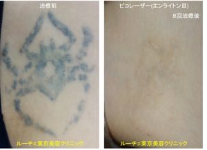 太もものクモのタトゥーにピコレーザーをしました