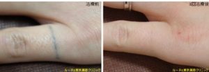 指自彫りタトゥー、とれた