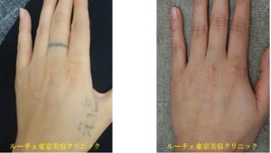 自彫りのタトゥーを消しました、とれた