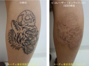 ふくらはぎのタトゥーに５度レーザー治療をしました